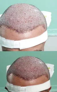کاشت مو شیرازی فول تراکم