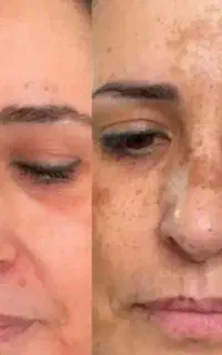 آموزش فرمو..ل سفیدکننده ضد لک ضد جوش تضمینی50هزار