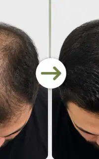 رشد مو بدون کاشت