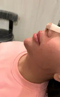تزریق ژل بوتاکس prp توسط پزشک در مطب باقیمت مناسب
