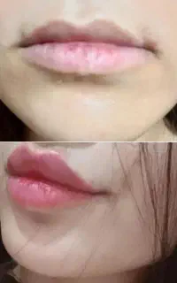 انجام تمامی خدمات فیلر و بوتاکس