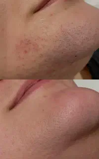 لیزرکل بدن موهای زائد ۲۰۲۶ فقط ۶۰۰ تومن