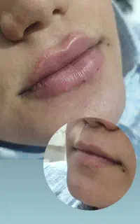 انواع ژل لب بوتاکس،خدمات ناخن ، انواع پیرسینگ