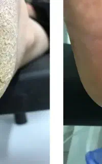 درمان ترک پا، پارافین تراپی، کاشت، لمینت