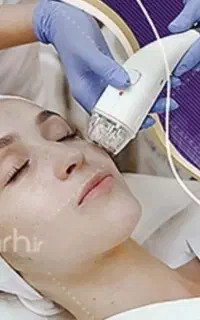 لیزرموهای زائد..جراحی زیبایی صورت
