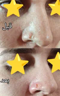 لیزر موهای زائدسوپرانو تیتانیوم برداشت انواع خال