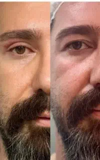 بلفاروپلاستی پلک، ژل، جراحی،لیزر،تزریق وساکشن چربی