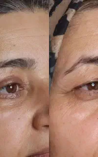 خدمات زیبایی پلاسما جت پلکسر تراپی صورت وفشیال