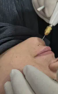 برطرف کردن خال و کک و مک ( دکتر علی بابایی)