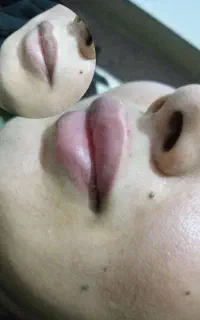 فیلر (ژل) سی سی ۸۰۰ فقط ۳ نفر