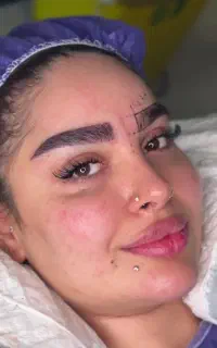 کاشت ابرو کاشت مو شیرازی با آف ویژه تابستانه