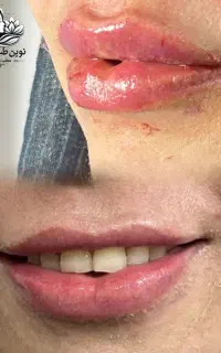 فیلر ، بوتاکس رفع لک پوست جوانسازی با بازگشت هزینه