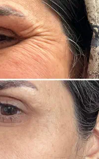 آموزش خصوصی و تزریق تخصصی فیلر و بوتاکس و پرسینگ