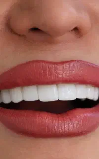 کامپوزیت زیبایی اقساط