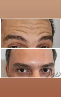 آموزش ژل و بوتاکس فیلر مزوتراپی تخفیف تا ۵۰ ٪