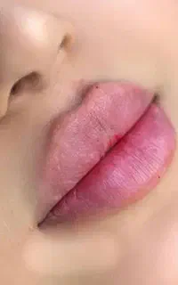 تزریق ژل وبوتاکس