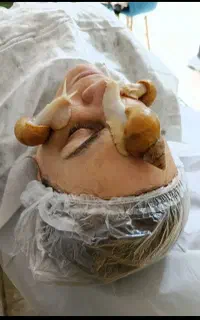 حلزون تراپی