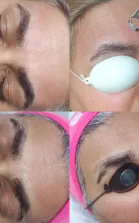 مرکز لیزر زیبا،لیزرموی مشکی سفیدخالبرداری،حذف تتو