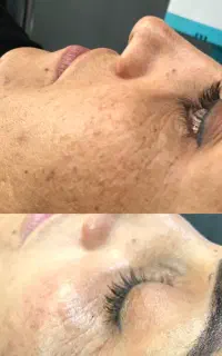 تجربه درخشش پوست /فشیال تخصصی پوست