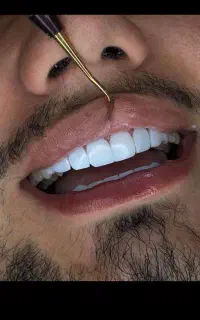 کامپوزیت دندان ازدم قسط بدون پیش پرداخت