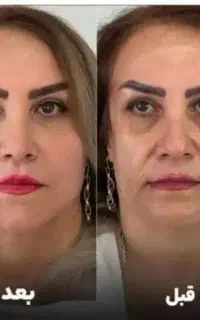جشنواره لیفت هایفو فقط امروز ۹۵۰ با۱۰ هدیه رایگان