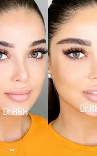 اقساط فیلربادی کانتورینگ ۳/۵ژل لب هیپدیپ کاشت ابرو