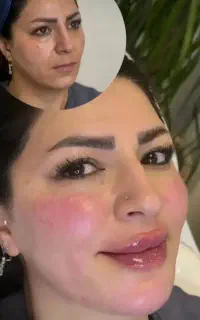 جشنواره تخفیف تزریق فیلر بوتاکس