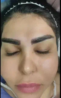 کاشت ابرو