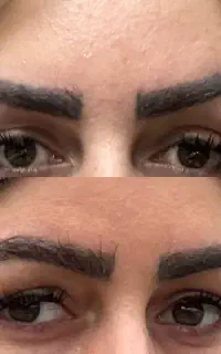 تزریق ژل بوتاکس فیلرجوانساز/اقساط بدون پیش پرداخت