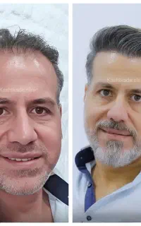 ۱۲ تومن تخفیف کاشت مو و ابرو