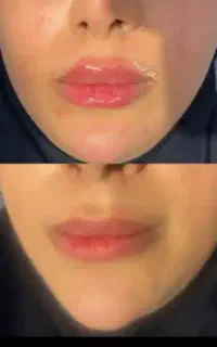 تزریق فیلر و بوتاکس توسط پزشک متخصص