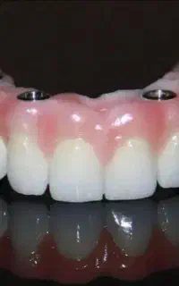 دندانپزشکی اوردنچر دوفک فقط ۱۸۵ تومن در تبریز