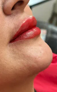 ساکشن و تزریق چربی