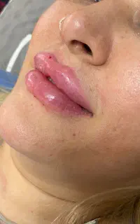 تزریق زل و بوتاکس تخصصی بدون درد