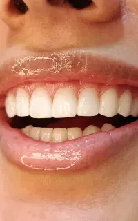 کامپوزیت/ ایمپلنت/ اقساط ۴ ماهه