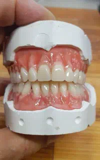 انواع پروتز دندان و روکش