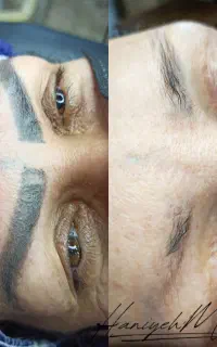 ریموو (پاک کردن)تتو های قدیمی بد رنگ یا بد شکل