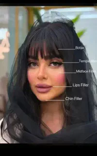 تزریق دقیق ژل،فیلر،bt مزو.فشیال وprpآنا طب اصلی