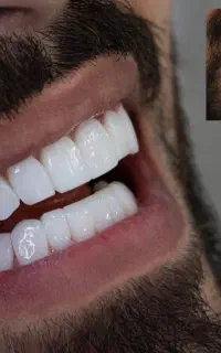 کامپوزیت و سرامیک دندان