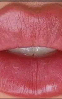 فیلرلب، بوتاکس