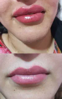 تزریق ژل وبوتاکس