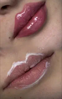 جشنواره ژل و بوتاکس فیلر توسط خانم دکتر چابکی