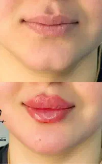 آف ویژه ژل (فیلر)بوتاکس مزو انزیم