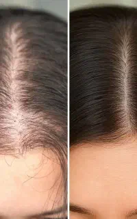 سلامت دوباره مو