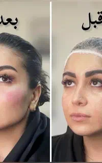 ساکشن غبغب ، لیفت با نخ و کانتورینگ صورت