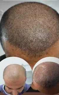 عمل بینی ساکشن کاشت مو غبغب ژل بوتاکس