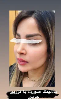 تزریق چربی
