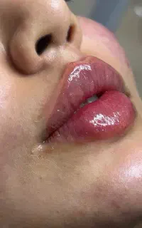 خدمات ژل و بوتاکس