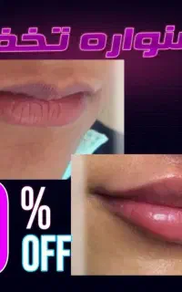 کلینیک تزریق ژل لب روسی فیلر چانه لیزر لیفت صورت
