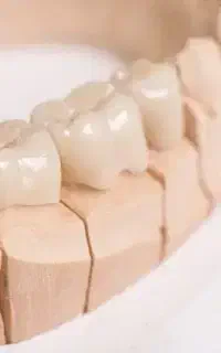 نیازمند یادگیریِ پرسلن گذاری(پروتز ثابت)